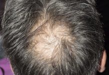 Losing hair not a generational thing