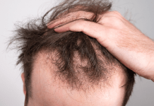 Study finds link between excessive sugary drinks and hair loss in men