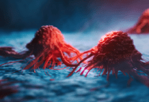 Rare cancer makes American man suddenly speak with Irish accent